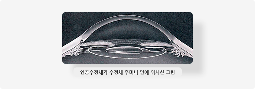 인공수정체가 수정체 주머니 안에 위치한 그림 이미지 입니다.