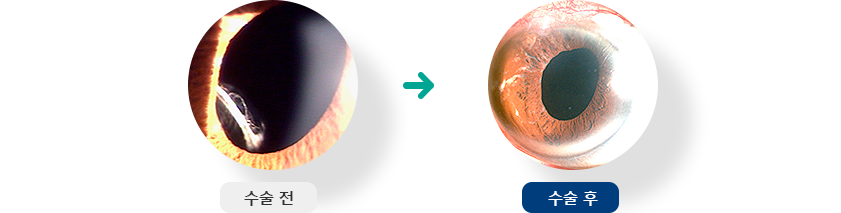 인공수정체 공막고정술 전 후 이미지 입니다.