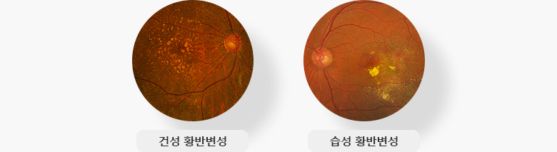 건성 황반변성, 습성 황반변성 예시 이미지 입니다.