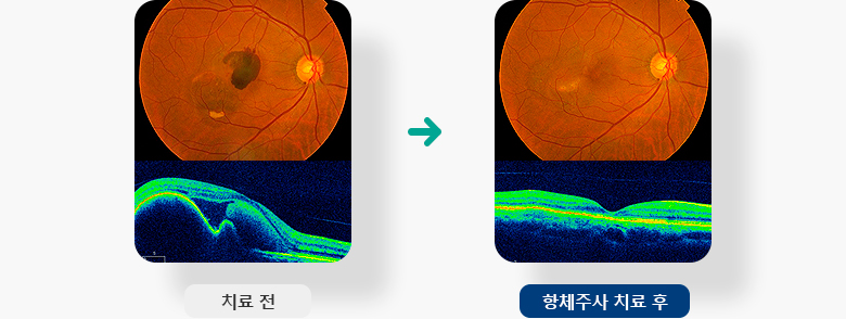 항체주사 치료 전 후 예시 이미지 입니다.
