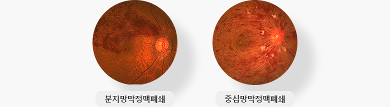 분지망막정맥폐쇄, 중심망막정맥폐쇄 예시 이미지 입니다.