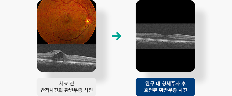 안구 내 항체주사 호전된 황반부종 전 후 예시 이미지 입니다.