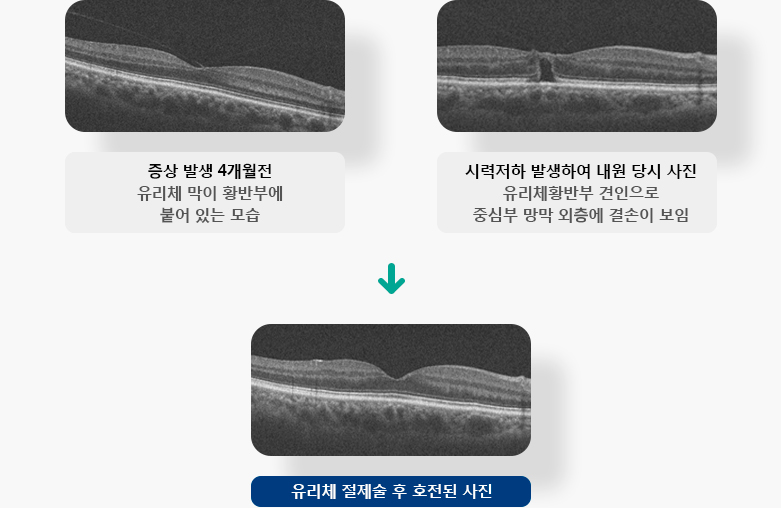 증상 발생 4개월전 유리체 막이 황반부에 붙어 있는 모습, 시력저하 발생하여 내원 당시 사진 유리체황반부 견인으로 중심부 망막 외층에 결손이 보임 , 유리체 절제술 후 호전된 사진 입니다.