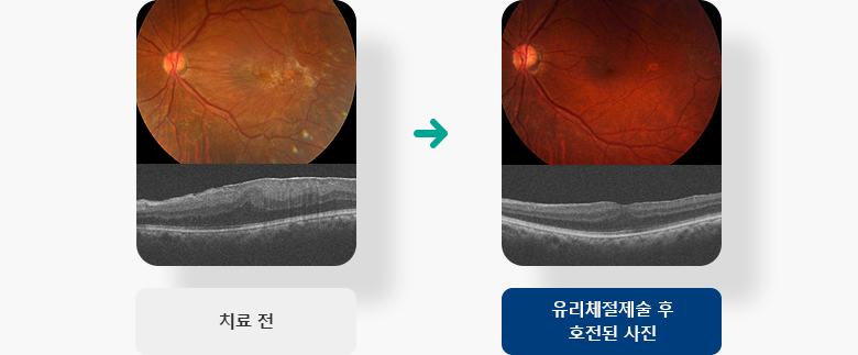 유리체 절제술 전 후 예시 이미지 입니다.