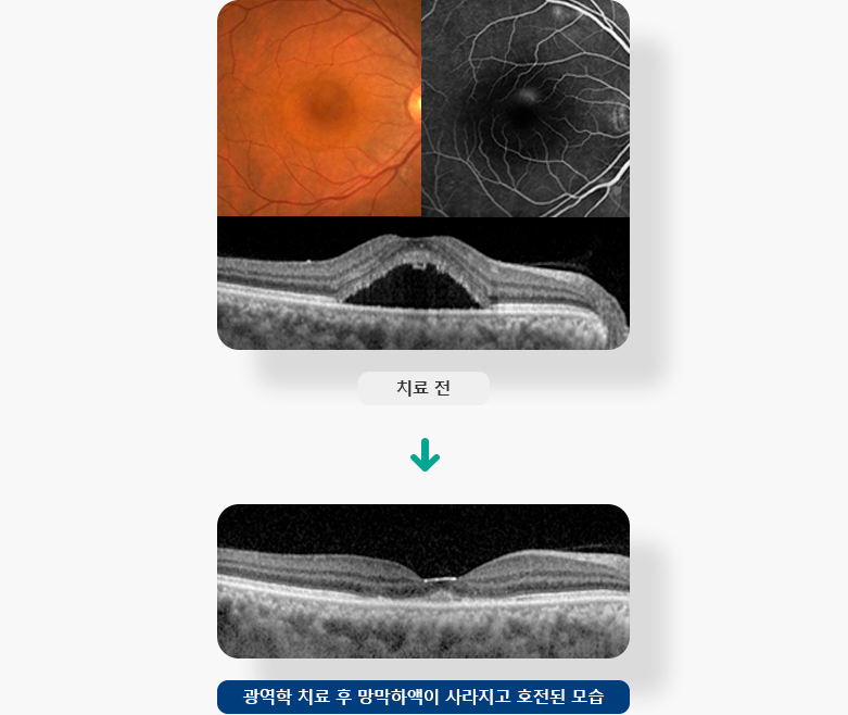 광역학 치료 후 망막하액이 사라지고 호전된 모습 이미지 입니다.