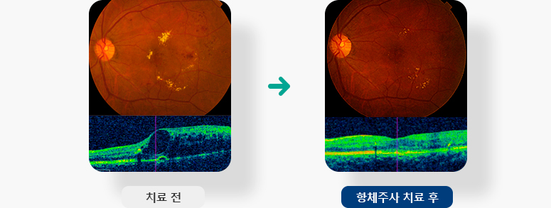 항체주사 치료 전 후 사례 이미지 입니다.