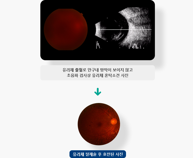 유리체 출혈로 안구내 망막이 보이지 않고 초음파 검사상 유리체 혼탁소견, 유리체 절제술 후 호전된 사진 이미지 입니다.