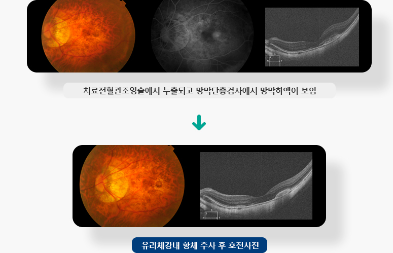 치료전혈관조영술에서 누출되고 망막단층검사에서 망막하액이 보임,  유리체강내 항체 주사 후 호전사진 이미지 입니다.