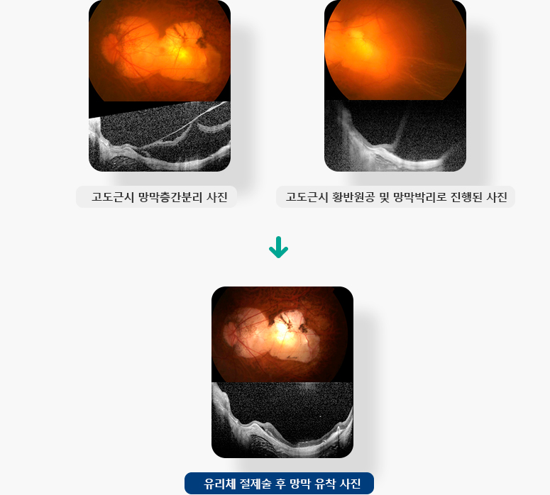 고도근시 망막층간분리, 고도근시 황반원공 및 망막박리로 진행된, 유리체 절제술 후 망막 유착 사진 입니다.