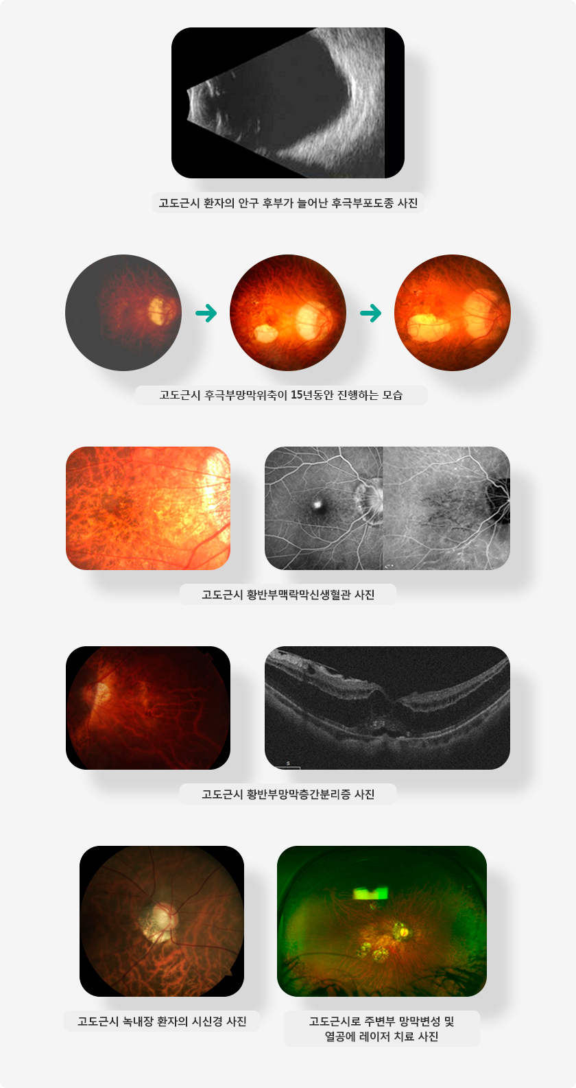 고도근시 환자의 안구 후부가 늘어난 후극부포도종 사진, 고도근시 후극부망막위축이 15년동안 진행하는 모습, 고도근시 황반부맥락막신생혈관 사진, 고도근시 황반부망막층간분리증 사진, 고도근시 녹내장 환자의 시신경 사진, 고도근시로 주변부 망막변성 및 열공에 레이저 치료 사진 입니다.