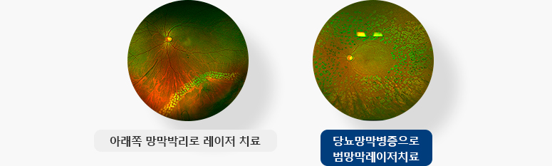 아래쪽 망막박리로 레이저 치료, 당뇨망막병증으로 범망막레이저치료 사진 입니다.