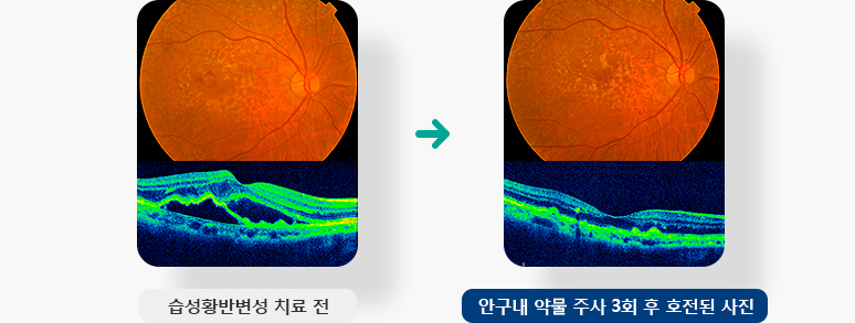 습성황반변성 치료 전, 안구내 약물 주사 3회 후 호전된 사진 입니다.