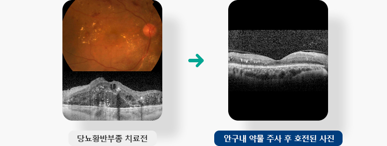 당뇨황반부종 치료전, 치료 3개월, 안구내 약물 주사 후 호전된 사진 입니다.