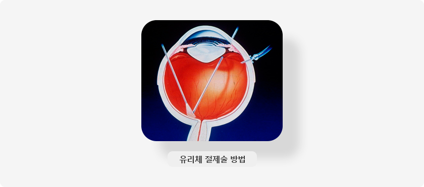 유리체 절제술 방법 사진 입니다.