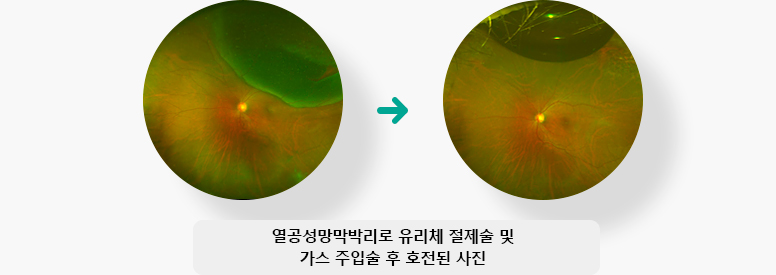 열공성망막박리로 유리체 절제술 및 가스 주입술 후 호전된 사진 입니다.