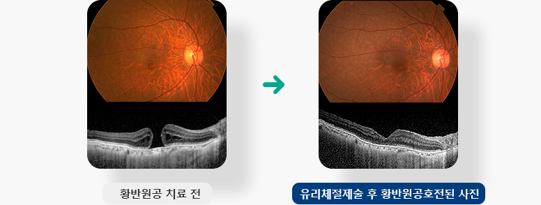 황반원공 치료 전,  유리체절제술 후 황반원공호전된 사진 입니다.