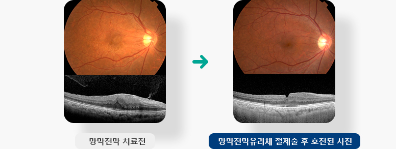 망막전막 치료전, 망막전막유리체 절제술 후 호전된 사진 입니다.