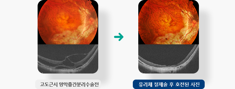 고도근시 망막층간분리수술전, 유리체 절제술 후 호전된 사진 입니다.