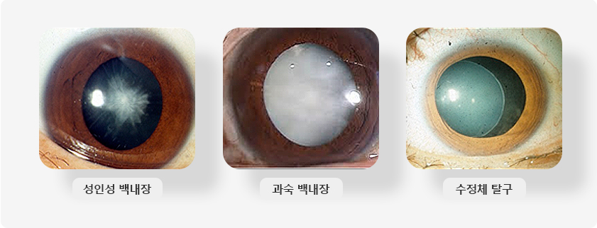 대표적인 백내장 및 수정체 질환(성인 백내장, 과숙 백내장, 수정체 탈구) 이미지 입니다.