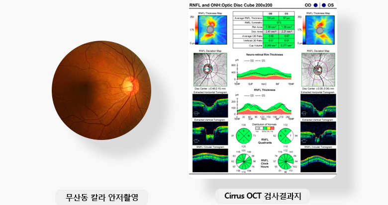 무산동 칼라 안저촬영, Cirrus OCT 검사결과지 이미지 입니다.