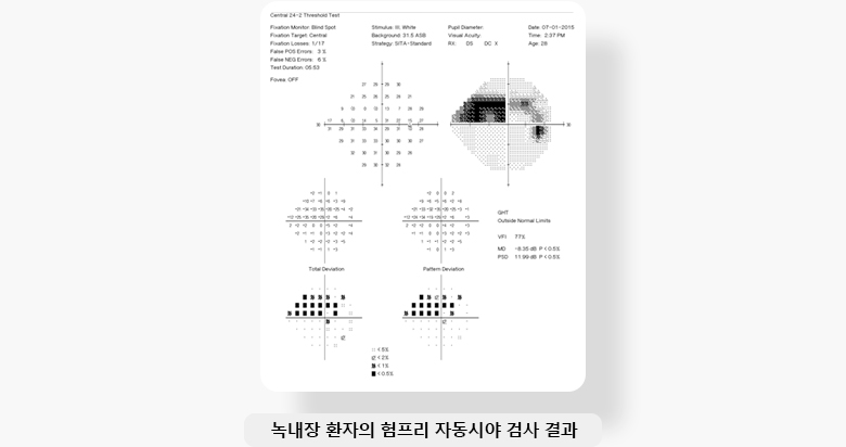 녹내장 환자의 험프리 자동시야 검사 결과 이미지 입니다.