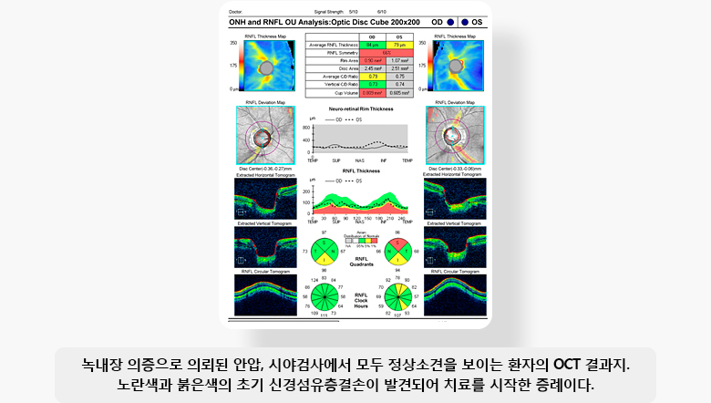 녹내장 의증으로 의뢰된 안압, 시야검사에서 모두 정상소견을 보이는 환자의 OCT 결과지. 노란색과 붉은색의 초기 신경섬유층결손이 발견되어 치료를 시작한 증례 이미지 입니다.